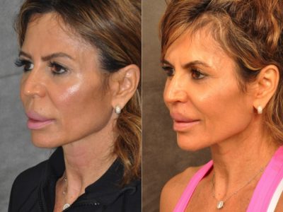 Modified Upper Lip Lift for Silicone Correction – Left Side
