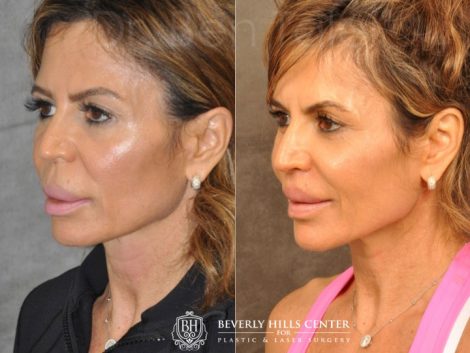 Modified Upper Lip Lift for Silicone Correction - Left Side