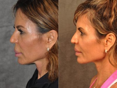 Modified Upper Lip Lift for Silicone Correction – Left Side