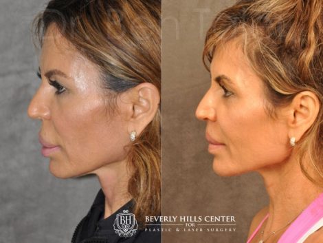 Modified Upper Lip Lift for Silicone Correction - Left Side