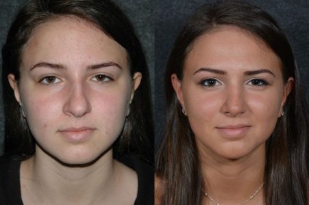 Minimally Invasive (Closed) Rhinoplasty - Front