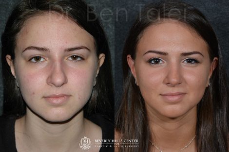 Minimally Invasive (Closed) Rhinoplasty - Front