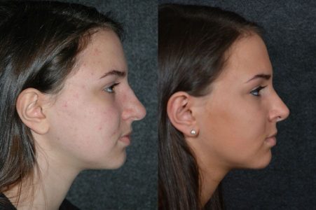 Minimally Invasive (Closed) Rhinoplasty - Right Side