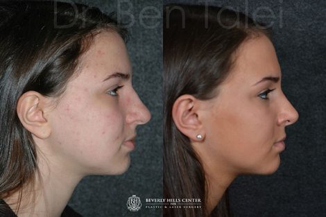 Minimally Invasive (Closed) Rhinoplasty - Right Side