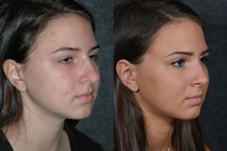 Minimally Invasive (Closed) Rhinoplasty - Right Side