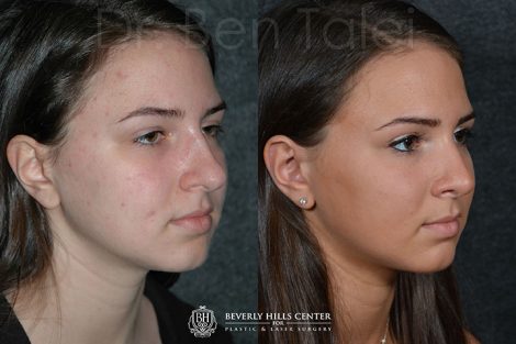 Minimally Invasive (Closed) Rhinoplasty - Right Side