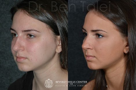 Minimally Invasive (Closed) Rhinoplasty - Left Side