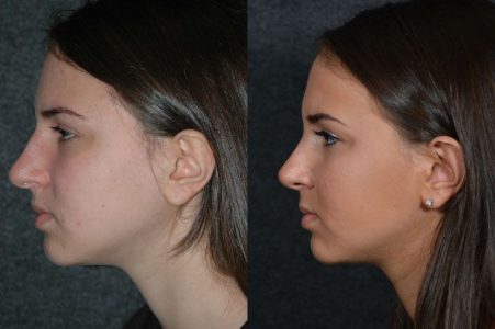 Minimally Invasive (Closed) Rhinoplasty - Left Side