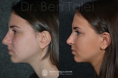 Minimally Invasive (Closed) Rhinoplasty - Left Side