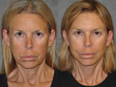 Awake & Painless Endoscopic Browlift and Deep Plane SMART Lift – Front