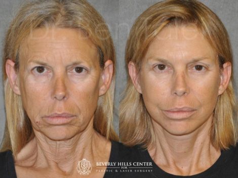 Awake & Painless Endoscopic Browlift and Deep Plane SMART Lift - Front