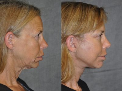 Awake & Painless Endoscopic Browlift and Deep Plane SMART Lift – Right Side