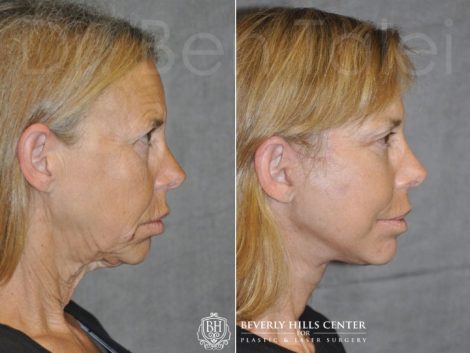 Awake & Painless Endoscopic Browlift and Deep Plane SMART Lift - Right Side