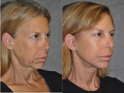 Awake & Painless Endoscopic Browlift and Deep Plane SMART Lift – Right Side