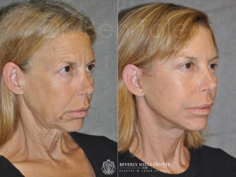 Awake & Painless Endoscopic Browlift and Deep Plane SMART Lift - Right Side