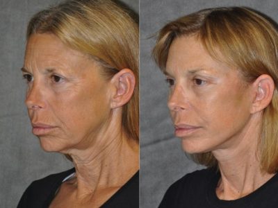 Awake & Painless Endoscopic Browlift and Deep Plane SMART Lift – Left Side