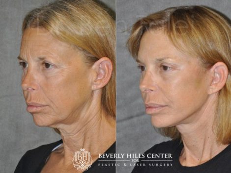 Awake & Painless Endoscopic Browlift and Deep Plane SMART Lift - Left Side