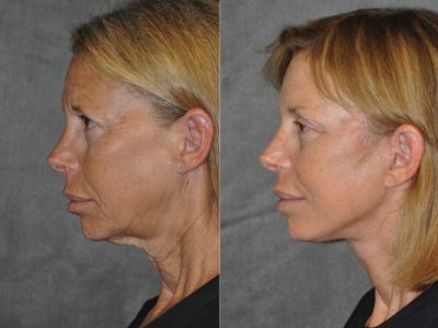 Awake & Painless Endoscopic Browlift and Deep Plane SMART Lift – Left Side