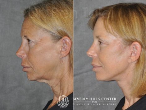 Awake & Painless Endoscopic Browlift and Deep Plane SMART Lift - Left Side