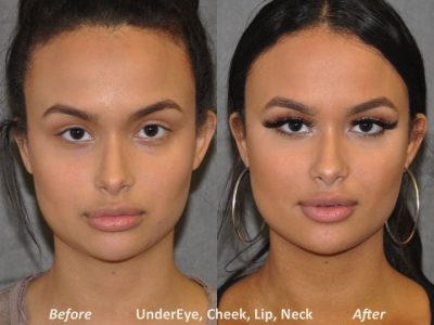 Neck MicroLiposuction with subtle UnderEye Refresh, Cheek Contour, Chin Projection, and Lip Enhancement - Front