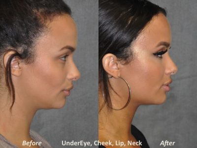 Neck MicroLiposuction with subtle UnderEye Refresh, Cheek Contour, Chin Projection, and Lip Enhancement - Right Side