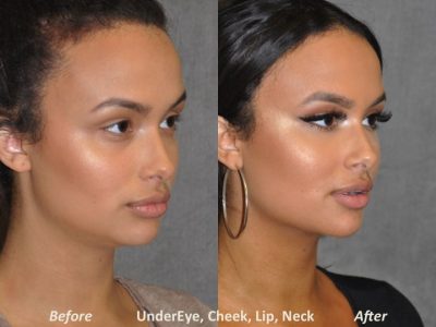 Neck MicroLiposuction with subtle UnderEye Refresh, Cheek Contour, Chin Projection, and Lip Enhancement - Right Side