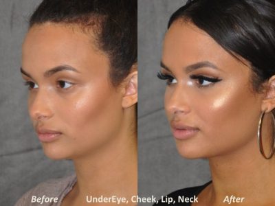 Neck MicroLiposuction with subtle UnderEye Refresh, Cheek Contour, Chin Projection, and Lip Enhancement - Left Side