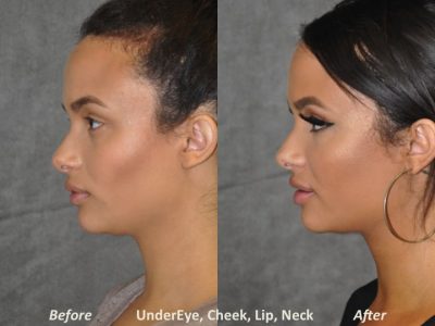 Neck MicroLiposuction with subtle UnderEye Refresh, Cheek Contour, Chin Projection, and Lip Enhancement - Left Side