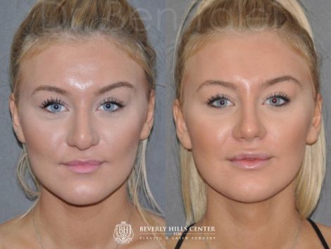 Minimally Invasive (Closed) REVISION Rhinoplasty - Front