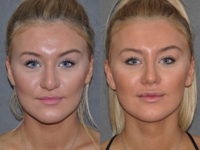Rhinoplasty and Lip Injections - Front