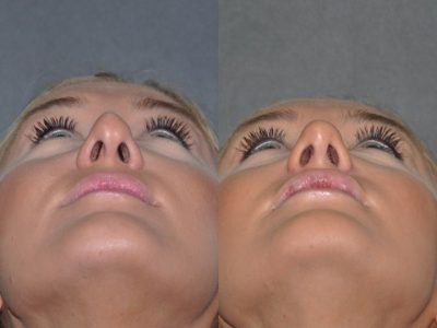 Rhinoplasty and Lip Injections - Front