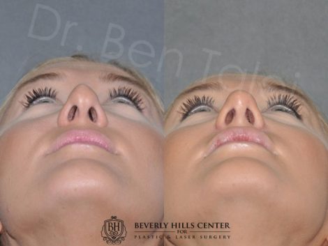 Rhinoplasty and Lip Injections - Front