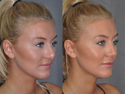 Rhinoplasty and Lip Injections - Right Side