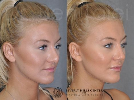 Rhinoplasty and Lip Injections - Right Side