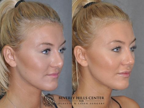 Minimally Invasive (Closed) REVISION Rhinoplasty - Right Side