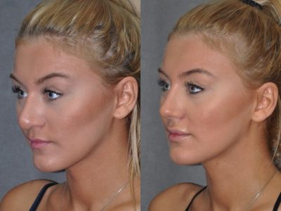 Minimally Invasive (Closed) REVISION Rhinoplasty - Right Side