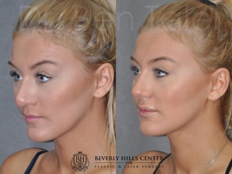 Minimally Invasive (Closed) REVISION Rhinoplasty - Right Side