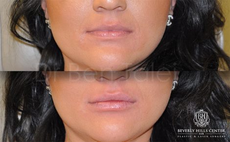 Beverly Hills Center Female Patient Before and After Non-surgical Lip Lift