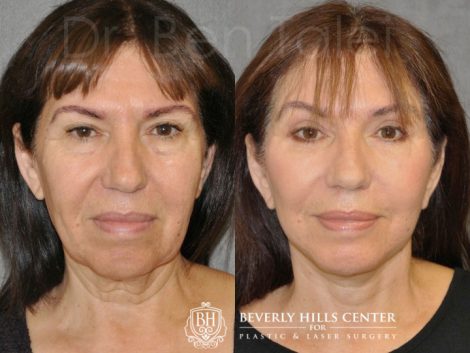 AuraLyft with Eyelid Rejuvenation - Front