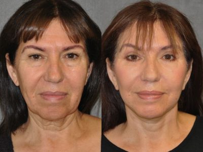 AuraLyft with Eyelid Rejuvenation - Front