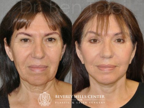 AuraLyft with Eyelid Rejuvenation - Front
