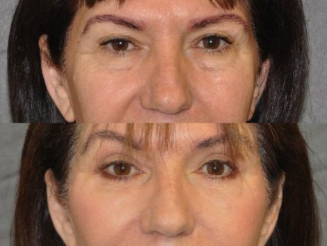 AuraLyft with Eyelid Rejuvenation - Front