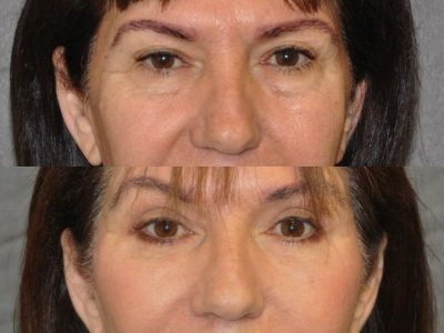 AuraLyft with Eyelid Rejuvenation - Front