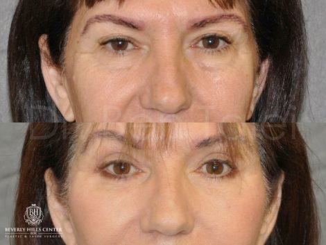 AuraLyft with Eyelid Rejuvenation - Front