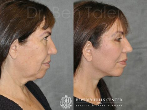 AuraLyft with Eyelid Rejuvenation - Right Side