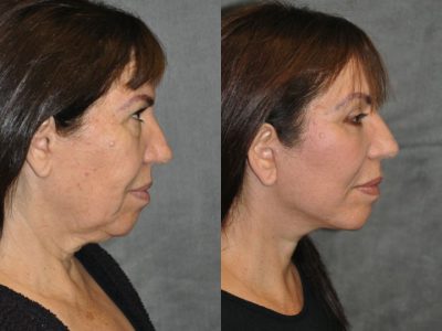 AuraLyft with Eyelid Rejuvenation - Right Side