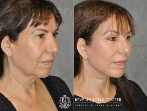 AuraLyft with Eyelid Rejuvenation - Right Side