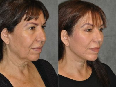 AuraLyft with Eyelid Rejuvenation - Right Side
