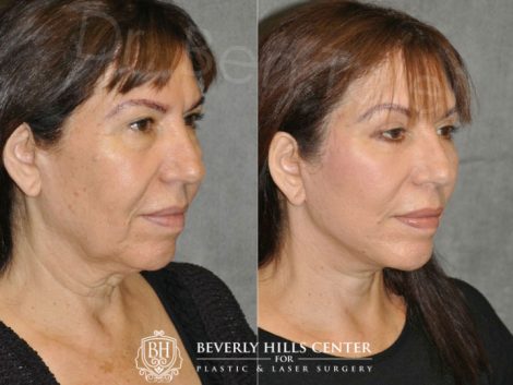 AuraLyft with Eyelid Rejuvenation - Right Side