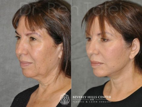 AuraLyft with Eyelid Rejuvenation - Left Side